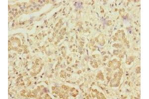 Immunohistochemistry of paraffin-embedded human pancreatic cancer using ABIN7167095 at dilution of 1:100 (RanBP3 抗体  (AA 1-250))