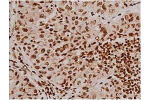 ABIN6267607 at 1/200 staining Human lung cancer tissue sections by IHC-P. (FAK 抗体  (pTyr397))