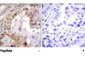 Immunohistochemical analysis of paraffin-embedded human lung carcinoma tissue using BCL2L1 polyclonal antibody . (BCL2L1 抗体)