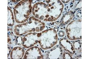 Immunohistochemical staining of paraffin-embedded Adenocarcinoma of ovary tissue using anti-LIPG mouse monoclonal antibody. (LIPG 抗体)