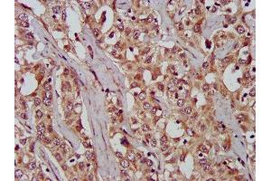 IHC image of ABIN7166315 diluted at 1:200 and staining in paraffin-embedded human liver cancer performed on a Leica BondTM system. (WNT8A 抗体  (AA 223-309))
