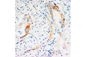 Immunohistochemical staining of CASP2 on formalin fixed, paraffin embedded human mammary cancer with CASP2 polyclonal antibody . (Caspase 2 抗体  (C-Term))