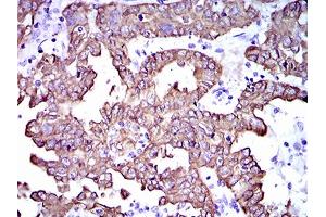 Immunohistochemical analysis of paraffin-embedded endometrial cancer tissues using CK5 mouse mAb with DAB staining. (Cytokeratin 5 抗体  (AA 316-590))