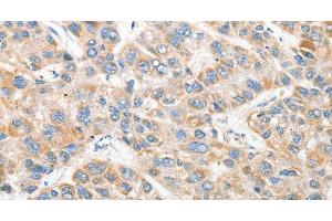 Immunohistochemistry of paraffin-embedded Human liver cancer tissue using ANAPC2 Polyclonal Antibody at dilution 1:30 (ANAPC2 抗体)
