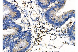 ABIN6257267 and ABIN6274157 at 1/100 staining Human colorectal cancer by IHC-P.
