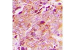 Immunohistochemical analysis of CEP76 staining in human breast cancer formalin fixed paraffin embedded tissue section. (Cep76 抗体)