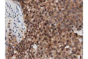 Immunohistochemical staining of paraffin-embedded Carcinoma of Human pancreas tissue using anti-PEPD mouse monoclonal antibody. (PEPD 抗体)