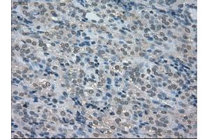 Immunohistochemical staining of paraffin-embedded Carcinoma of thyroid tissue using anti-BUB1Bmouse monoclonal antibody. (BUB1B 抗体)