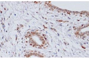 Immunohistochemistry of paraffin-embedded Human breast cancer using TriMethyl-Histone H3-K27 Polyclonal Antibody at dilution of 1:100 (40x lens). (Histone 3 抗体  (3meLys27))