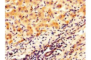 IHC image of ABIN7159817 diluted at 1:300 and staining in paraffin-embedded human liver cancer performed on a Leica BondTM system. (OGN 抗体  (AA 21-298))