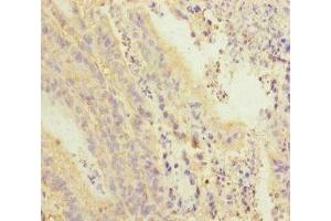 Immunohistochemistry of paraffin-embedded human colon cancer using ABIN7168417 at dilution of 1:100 (PDE6A 抗体  (AA 656-860))