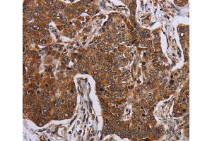Immunohistochemistry of Human liver cancer using ACP6 Polyclonal Antibody at dilution of 1:30