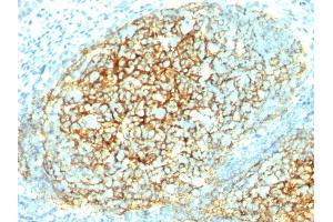 Formalin-fixed, paraffin-embedded human Tonsil stained with CD106 Monoclonal Antibody (1. (VCAM1 抗体)