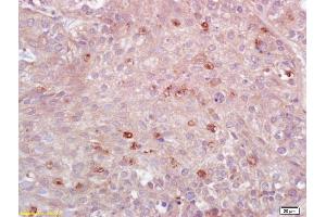 Formalin-fixed and paraffin embedded human lung carcinoma labeled with Anti-MHC Class II/HLA-DPB1 Polyclonal Antibody, Unconjugated (ABIN753928) at 1:200 followed by conjugation to the secondary antibody and DAB staining. (HLA-DPB1 抗体  (AA 101-210))