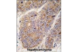 Formalin-fixed and paraffin-embedded human hepatocarcinoma tissue reacted with OA2 antibody (Center) 7422c , which was peroxidase-conjugated to the secondary antibody, followed by DAB staining. (APOA2 抗体  (AA 28-56))