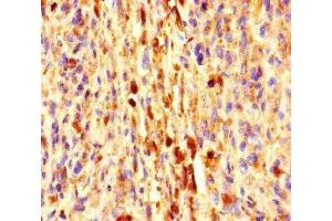 Immunohistochemistry of paraffin-embedded human melanoma using ABIN7152273 at dilution of 1:100 (Exophilin 5 抗体  (AA 1235-1490))