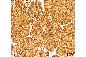 IHC staining of melanoma tissue (10X) with Tyrosinase antibody (T311). (TYR 抗体)