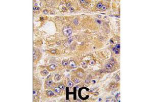 Formalin-fixed and paraffin-embedded human hepatocellular carcinoma reacted with LDLRAP1 polyclonal antibody  , which was peroxidase-conjugated to the secondary antibody, followed by DAB staining. (LDLRAP1 抗体  (C-Term))