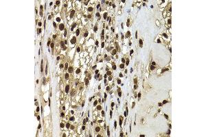 Immunohistochemistry of paraffin-embedded human kidney cancer using ACTL6B antibody at dilution of 1:100 (x400 lens). (Actin-Like 6B 抗体)