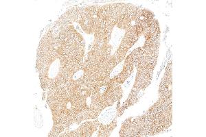 Immunohistochemistry (IHC) image for anti-Metadherin (MTDH) (AA 475-525) antibody (ABIN7795651) (Recombinant MTDH 抗体  (AA 475-525))