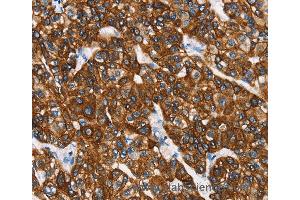 Immunohistochemistry of Human breast cancer using KRT8 Polyclonal Antibody at dilution of 1:40 (KRT8 抗体)