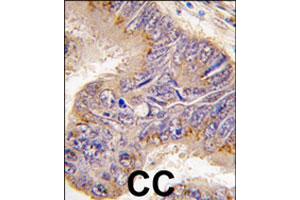 Formalin-fixed and paraffin-embedded human colon carcinoma tissue reacted with RPS6 polyclonal antibody  , which was peroxidase-conjugated to the secondary antibody, followed by DAB staining. (RPS6 抗体  (N-Term))