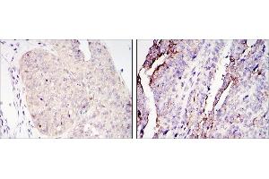 Immunohistochemical analysis of paraffin-embedded ovary tumour tissues (left) and lung cancer (right) using CRTC2 antibody with DAB staining. (CRTC2 抗体)