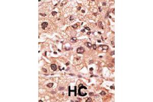 Formalin-fixed and paraffin-embedded human hepatocellular carcinoma tissue reacted with MAGEF1 polyclonal antibody  , which was peroxidase-conjugated to the secondary antibody, followed by AEC staining. (MAGEF1 抗体  (C-Term))