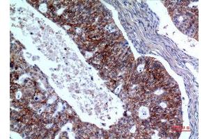 Immunohistochemistry (IHC) analysis of paraffin-embedded Human Ovarian Cancer, antibody was diluted at 1:100.