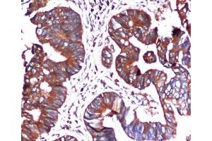 Immunohistochemical analysis of paraffin-embedded Colorectal cancer using BiP/GRP78 (C-terminus) Mouse mAb (1/100 dilution). (GRP78 抗体  (C-Term))
