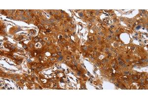 Immunohistochemistry of paraffin-embedded Human lung cancer using PLAUR Polyclonal Antibody at dilution of 1:60 (PLAUR 抗体)