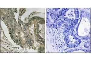 Immunohistochemistry analysis of paraffin-embedded human colon carcinoma tissue, using ALDOC Antibody. (ALDOC 抗体  (AA 61-110))