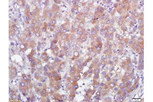 Paraformaldehyde-fixed, paraffin embedded human liver carcinoma tissue, Antigen retrieval by boiling in sodium citrate buffer(pH6) for 15min, Block endogenous peroxidase by 3% hydrogen peroxide for 30 minutes, Blocking buffer (normal goat serum) at 37°C for 20min, Antibody incubation with GPR110 Polyclonal Antibody, Unconjugated  at 1:500 overnight at 4°C, followed by a conjugated secondary and DAB staining (G Protein-Coupled Receptor 110 抗体  (AA 51-150))