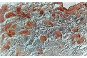 Immunhistochemical analysis in adipocytes of human breast carcinoma tissue using MKI67IP polyclonal antibody  at 1 : 500 dilution. (NIFK 抗体  (AA 144-160))