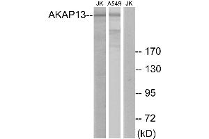 Immunohistochemistry analysis of paraffin-embedded human lung carcinoma tissue using AKAP13 antibody. (AKAP13 抗体)