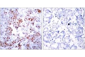 Immunohistochemistry analysis of paraffin-embedded human breast carcinoma tissue, using ATF2 (Ab-69 or 51) Antibody. (ATF2 抗体  (AA 35-84))