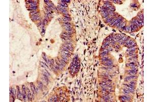 Immunohistochemistry of paraffin-embedded human colon cancer using ABIN7160959 at dilution of 1:100 (NDUFS4 抗体  (AA 43-161))