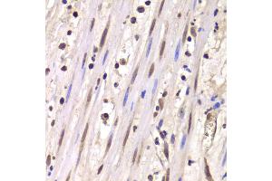 Immunohistochemistry of paraffin-embedded human mammary cancer using LSM4 antibody (ABIN1980258) at dilution of 1:100 (40x lens). (LSM4 抗体)