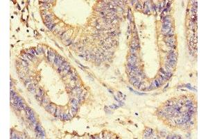 Immunohistochemistry of paraffin-embedded human endometrial cancer using ABIN7143597 at dilution of 1:100 (ASIP 抗体  (AA 23-112))