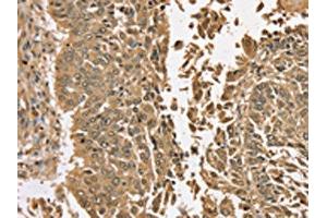 The image on the left is immunohistochemistry of paraffin-embedded Human lung cancer tissue using (TGM6 Antibody) at dilution 1/35, on the right is treated with synthetic peptide. (TGM6 抗体)