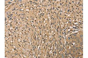 The image on the left is immunohistochemistry of paraffin-embedded Human cervical cancer tissue using ABIN7131042(SETD2 Antibody) at dilution 1/40, on the right is treated with fusion protein.