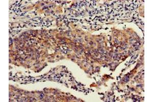 Immunohistochemistry of paraffin-embedded human cervical cancer using ABIN7151111 at dilution of 1:100 (RBBP6 抗体  (AA 51-97))