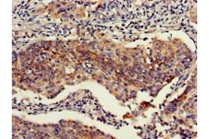 Immunohistochemistry of paraffin-embedded human cervical cancer using ABIN7151111 at dilution of 1:100 (RBBP6 抗体  (AA 51-97))
