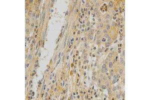 Immunohistochemistry of paraffin-embedded human stomach cancer using TNFRSF11B antibody at dilution of 1:200 (x400 lens) (Osteoprotegerin 抗体)