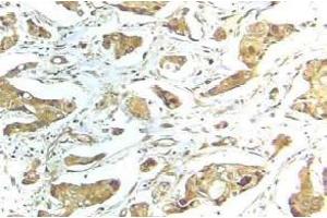 Immunohistochemistry (IHC) analyzes of STAT1 antibody in paraffin-embedded human breast carcinoma tissue. (STAT1 抗体)