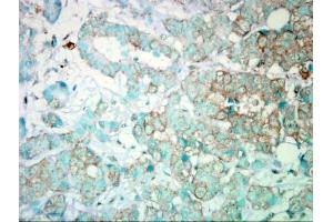 IHC-P Image Immunohistochemical analysis of paraffin-embedded Human Breast Cancer, using PI3 kinase p110 alpha, antibody. (PIK3CA 抗体  (N-Term))
