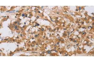 Immunohistochemistry of paraffin-embedded Human thyroid cancer tissue using RAD54L2 Polyclonal Antibody at dilution 1:40 (ARIP4 抗体)