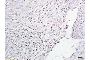 Formalin-fixed and paraffin embedded human endometrial cancer labeled with Anti-Notch1/MOTC Polyclonal Antibody, Unconjugated (ABIN675114) followed by conjugation to the secondary antibody and DAB staining (Notch1 抗体  (AA 2101-2300))