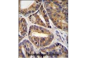 RN Antibody (C-term) (ABIN655838 and ABIN2845252) immunohistochemistry analysis in formalin fixed and paraffin embedded human prostate carcinoma tissue followed by peroxidase conjugation of the secondary antibody and DAB staining. (RNF215 抗体  (C-Term))