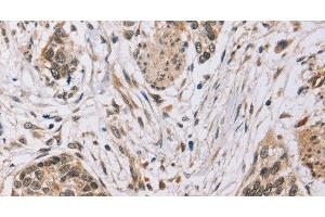 Immunohistochemistry of paraffin-embedded Human esophagus cancer tissue using PDLIM7 Polyclonal Antibody at dilution 1:35 (PDLIM7 抗体)